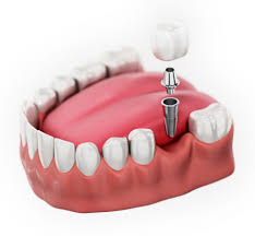 Single Tooth Dental Implant