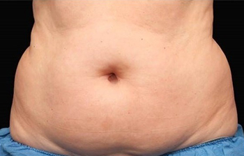 CoolSculpting Melbourne