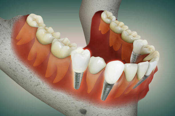 dental implants in Northeast Philadelphia
